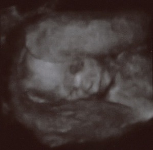 3-D ultrasound of Baby Bauer.